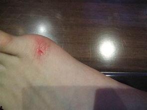 脚伤了图片,脚伤困扰下的生活挑战与康复之路
